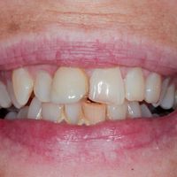 Porcelain Veneers - Smile 4 before
